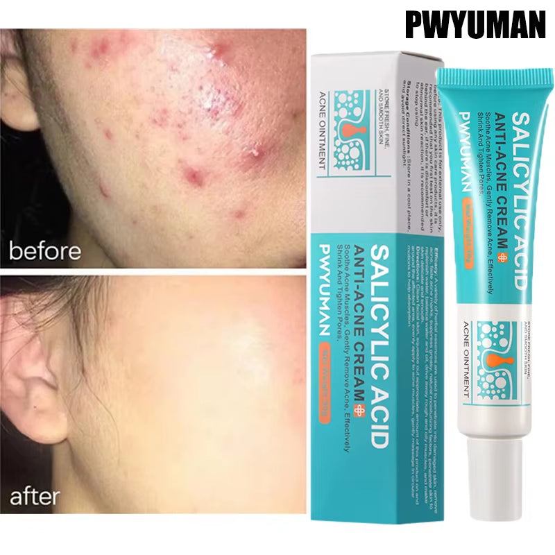 Salicylic Acid Acne Treatment Face Cream Repair Pimple Spots Deep Cleaning Pore Anti-Acne Scar Oil Control Moisturizer Skin Care