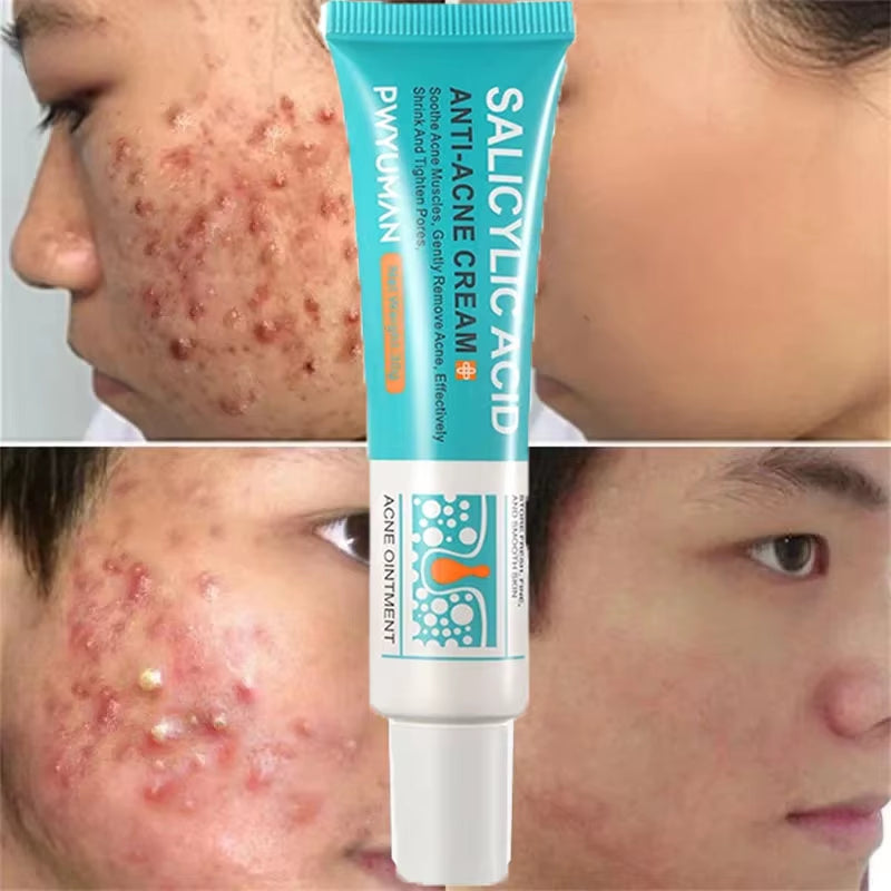 Salicylic Acid Acne Treatment Face Cream Repair Pimple Spots Deep Cleaning Pore Anti-Acne Scar Oil Control Moisturizer Skin Care