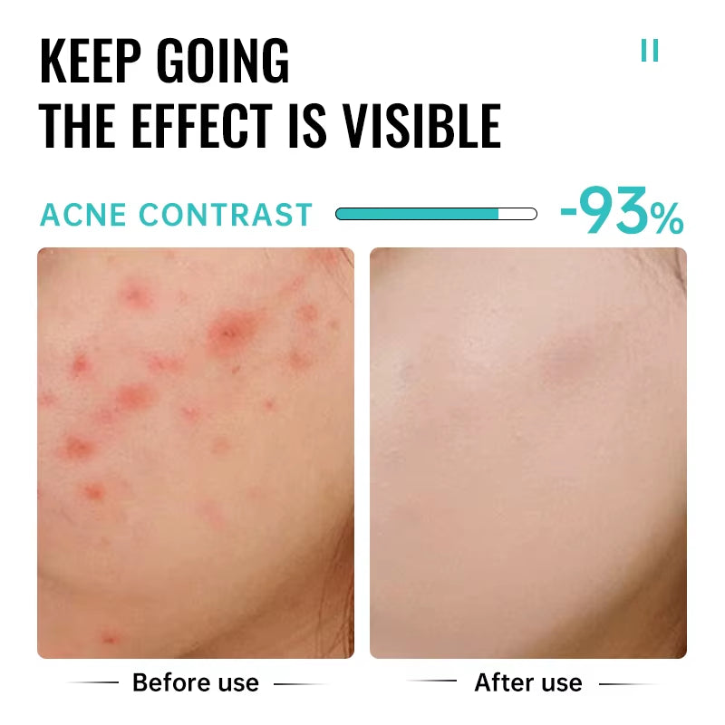 Salicylic Acid Acne Treatment Face Cream Repair Pimple Spots Deep Cleaning Pore Anti-Acne Scar Oil Control Moisturizer Skin Care