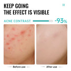 Salicylic Acid Acne Treatment Face Cream Repair Pimple Spots Deep Cleaning Pore Anti-Acne Scar Oil Control Moisturizer Skin Care