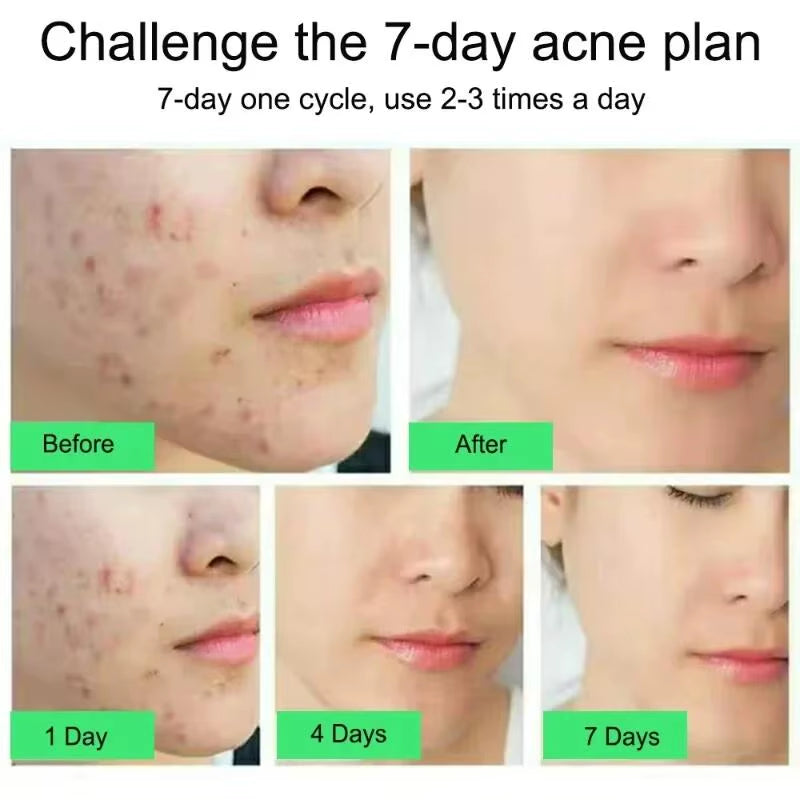 Salicylic Acid Acne Treatment Face Cream Repair Pimple Spots Deep Cleaning Pore Anti-Acne Scar Oil Control Moisturizer Skin Care